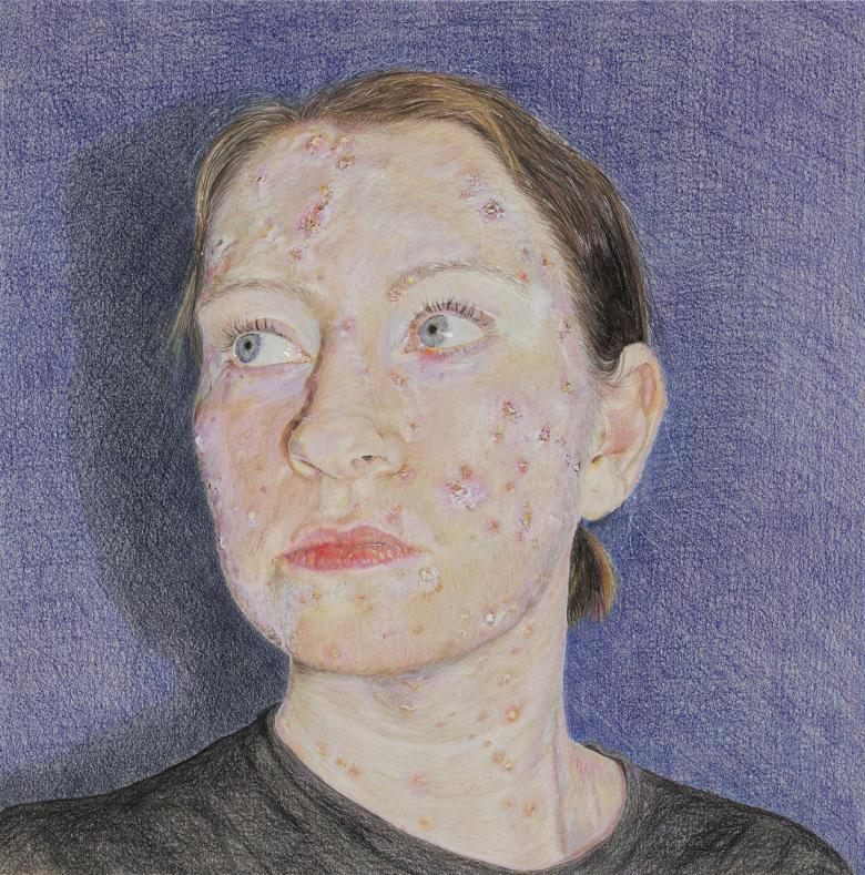 A coloured pencil drawing of a woman, her face and neck covered in chicken pox marks. She stands against a blue background, her fact turned to the side.