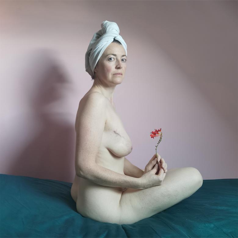 A nude woman sits cross legged on a bed, showing her scars from breast cancer surgery.