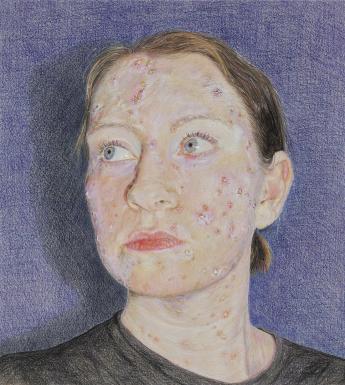 A coloured pencil drawing of a woman, her face and neck covered in chicken pox marks. She stands against a blue background, her fact turned to the side.
