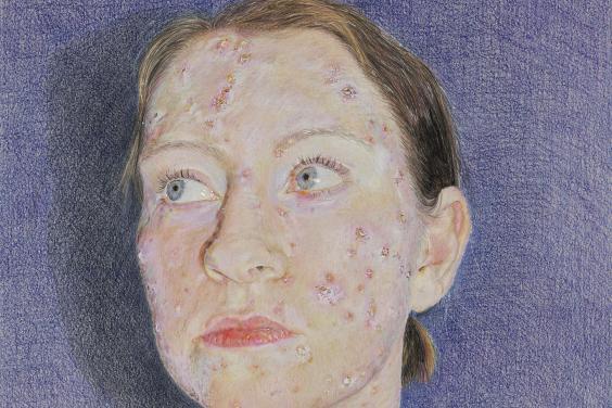 A coloured pencil drawing of a woman, her face and neck covered in chicken pox marks. She stands against a blue background, her fact turned to the side.